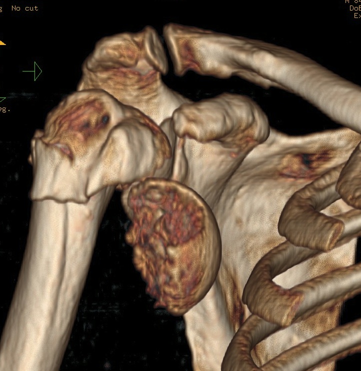 Shoulder Fracture Dislocation